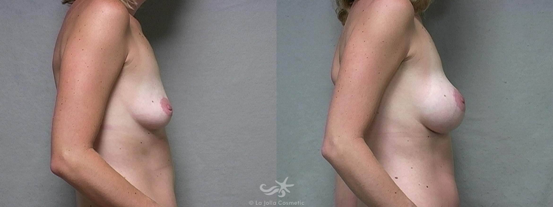 Before & After Breast Augmentation Result 445 Right Side View in San Diego, CA