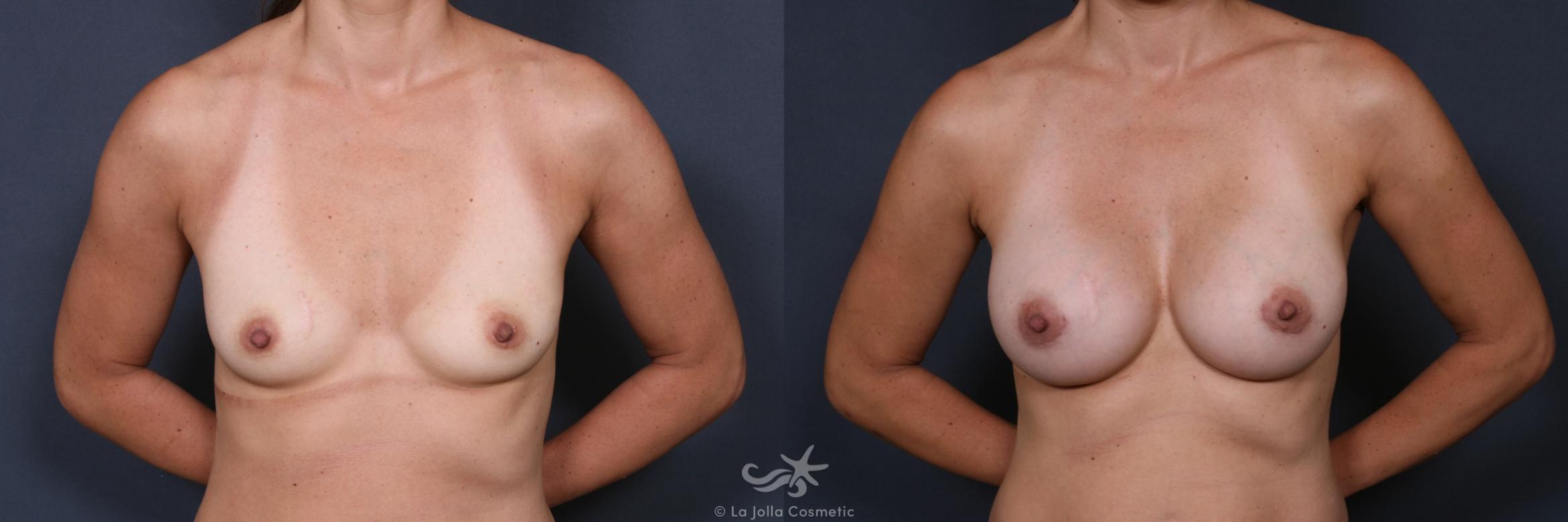 Before & After Breast Augmentation Result 446 Front View in San Diego, CA