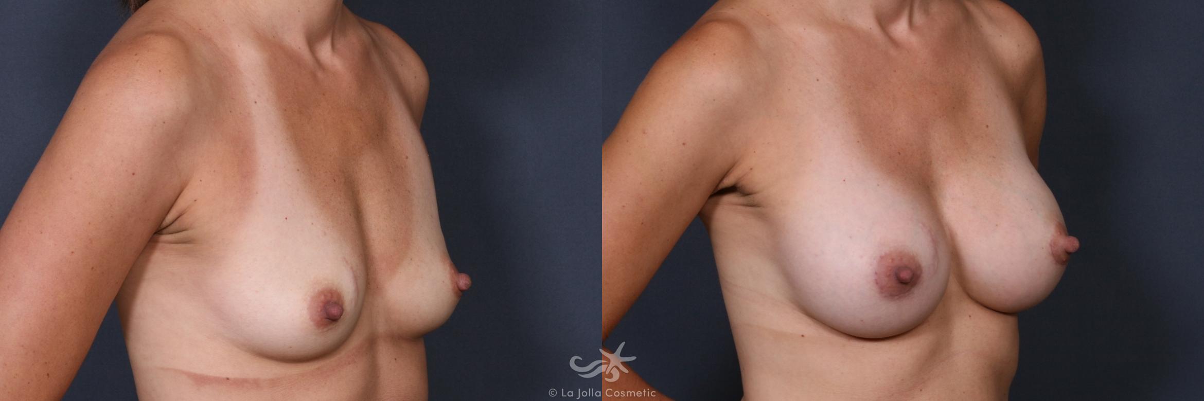 Before & After Breast Augmentation Result 446 Right Oblique View in San Diego, CA