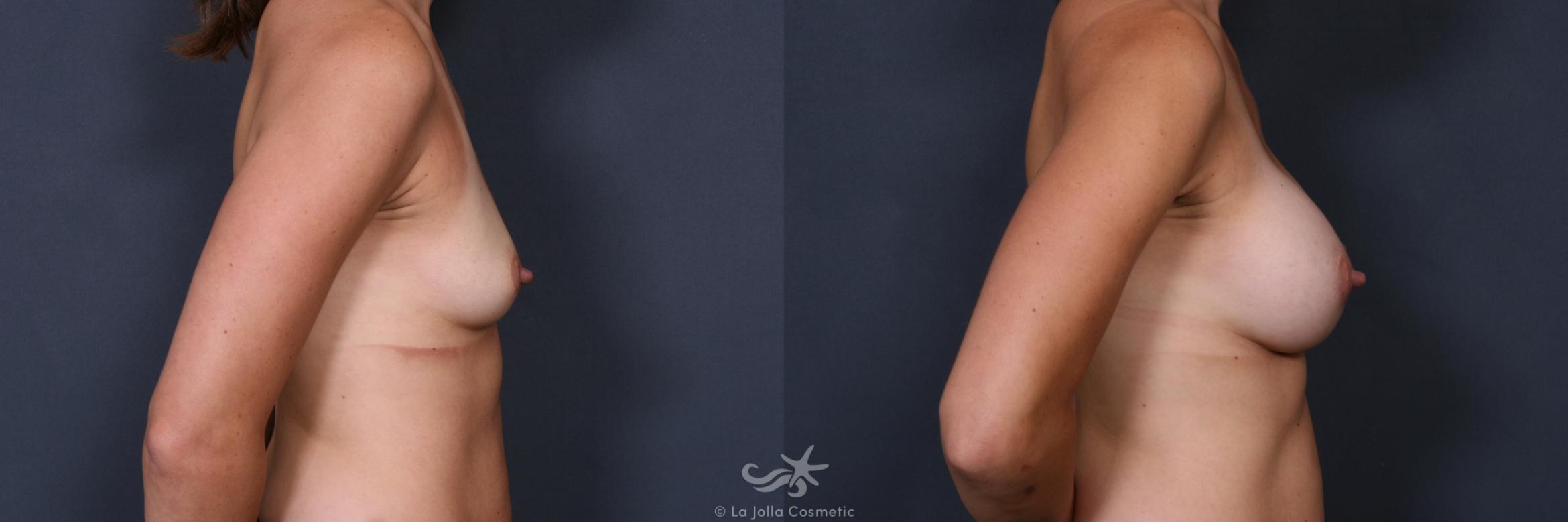 Before & After Breast Augmentation Result 446 Right Side View in San Diego, CA