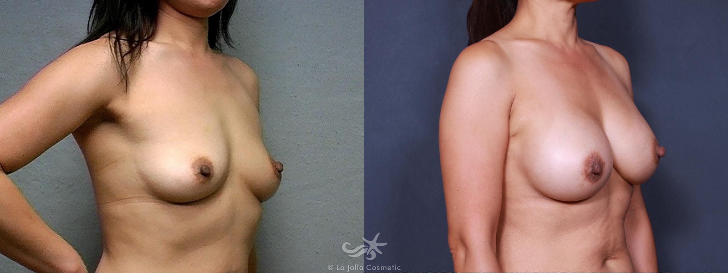 Before & After Breast Augmentation Result 448 Right Oblique View in San Diego, CA