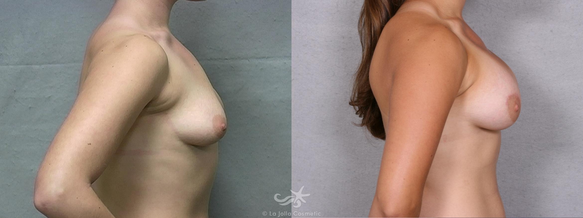 Before & After Breast Augmentation Result 449 Right Side View in San Diego, CA