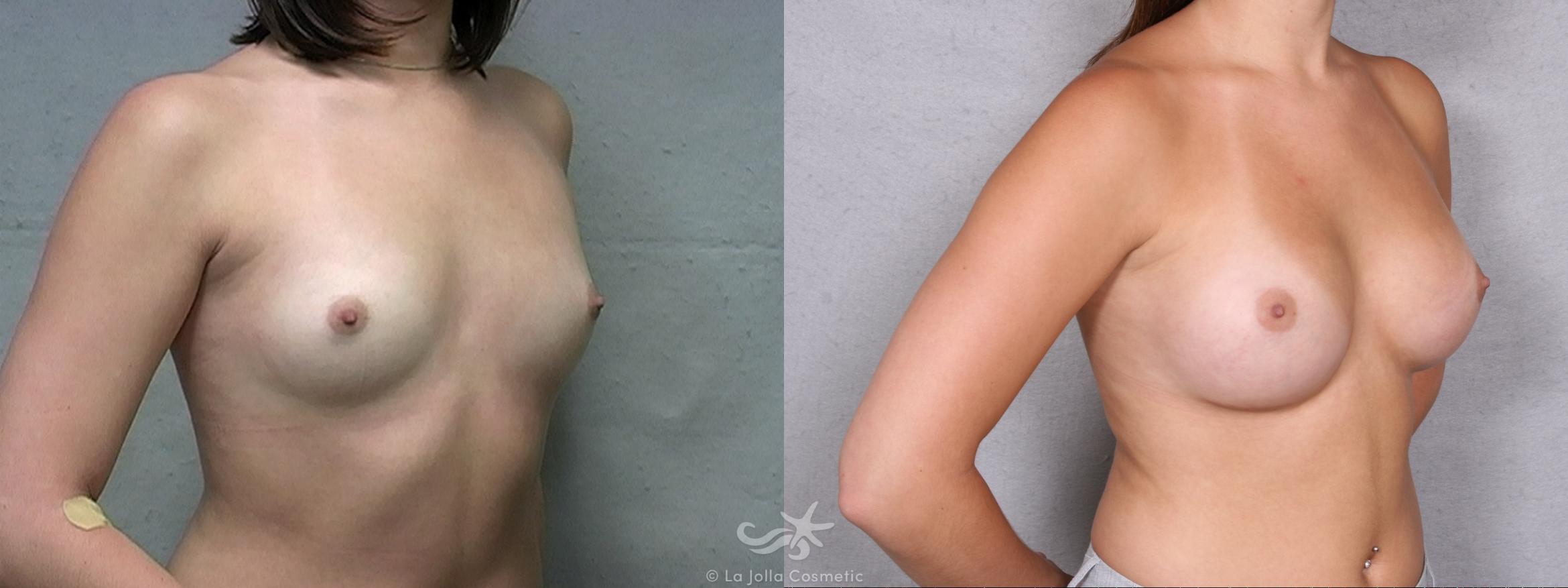 Before & After Breast Augmentation Result 451 Right Oblique View in San Diego, CA