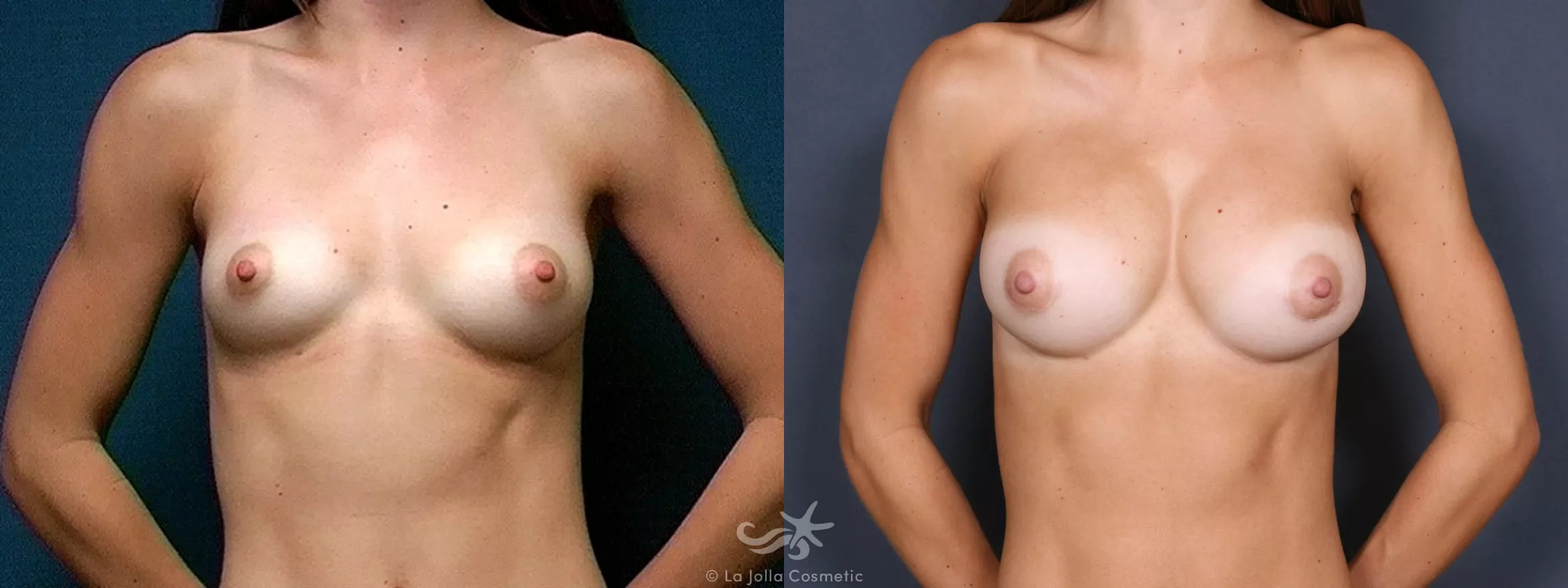 Before & After Breast Augmentation Result 452 Front View in San Diego, CA