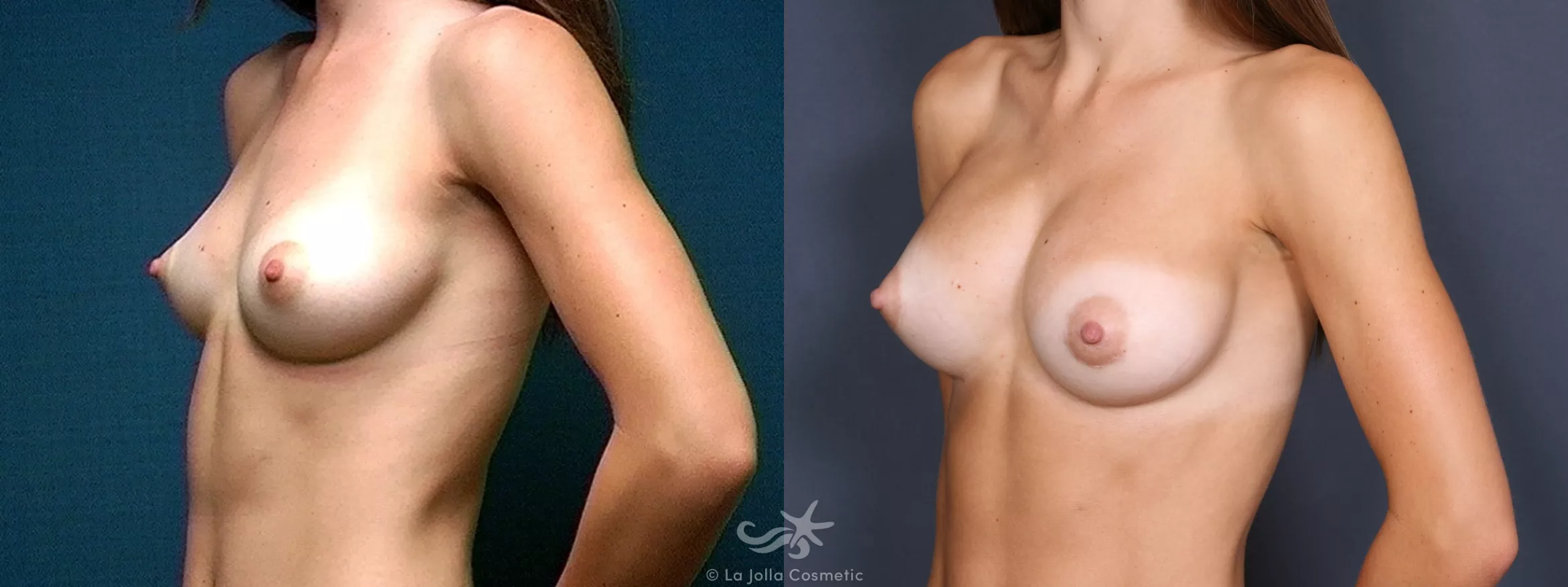Before & After Breast Augmentation Result 452 Left Oblique View in San Diego, CA