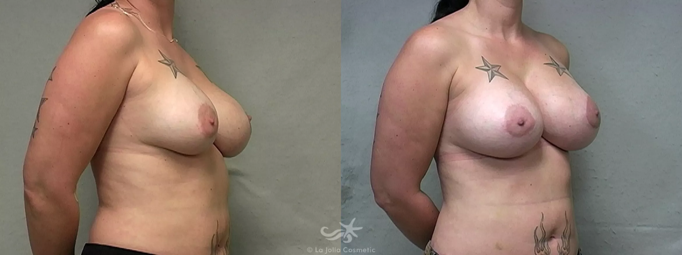 Before & After Breast Augmentation Result 454 Right Oblique View in San Diego, CA