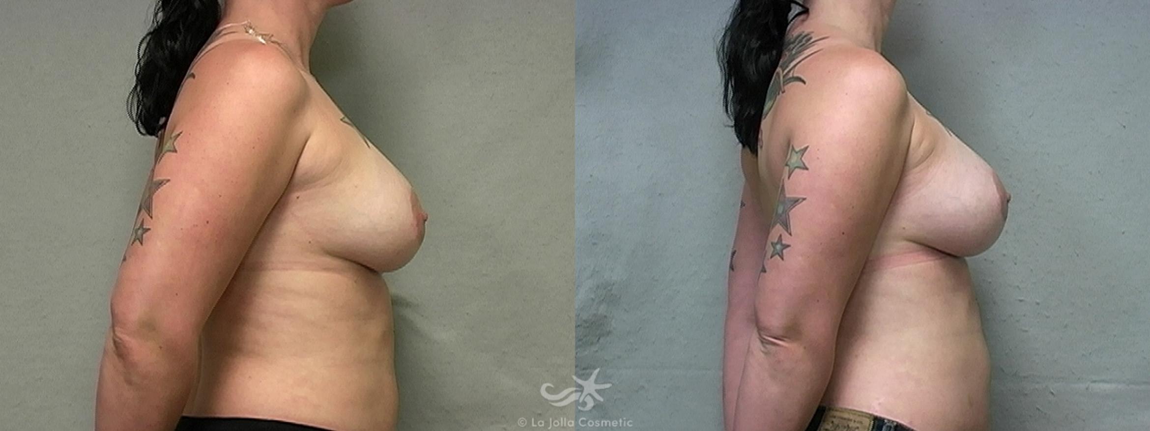 Before & After Breast Augmentation Result 454 Right Side View in San Diego, CA