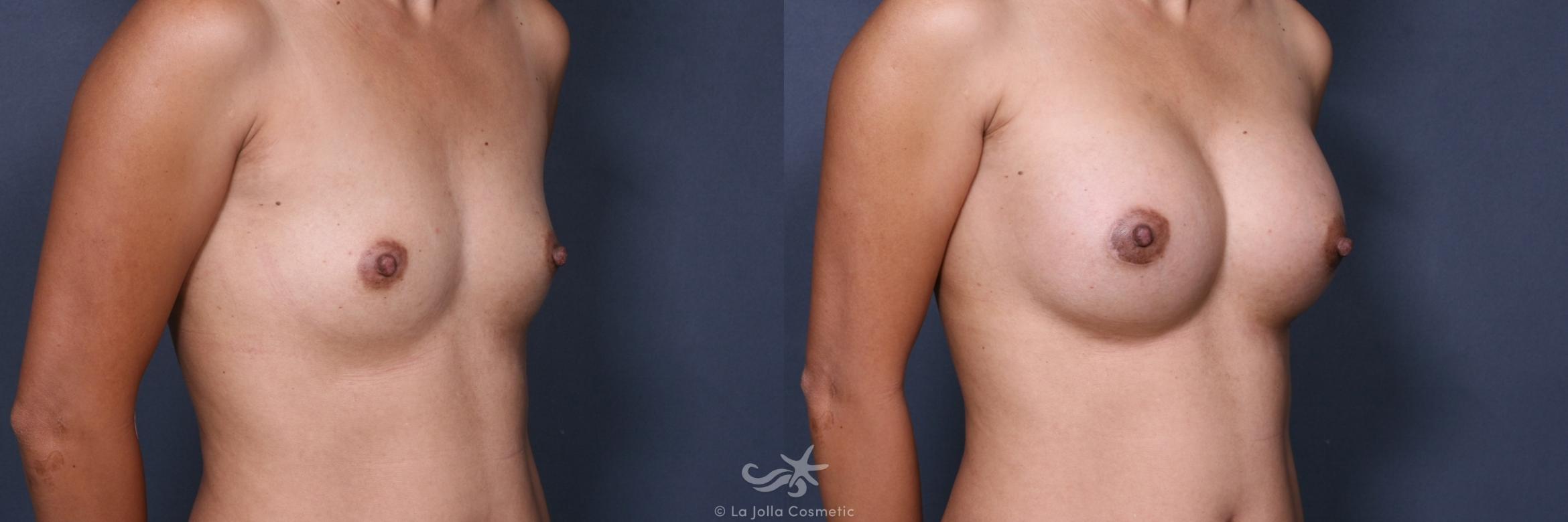 Before & After Breast Augmentation Result 461 Right Oblique View in San Diego, CA
