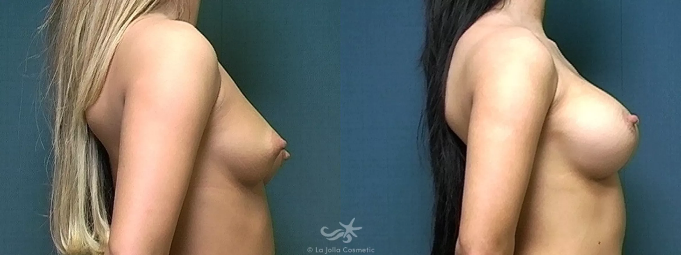 Before & After Breast Augmentation Result 474 Right Side View in San Diego, CA