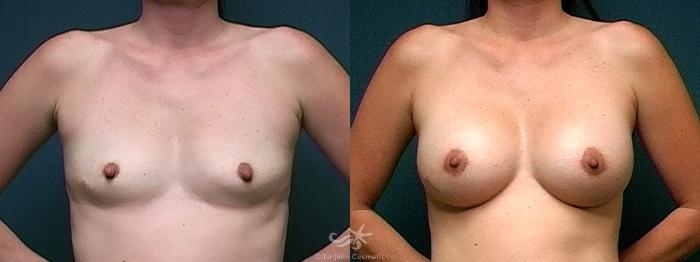 Before & After Breast Augmentation Result 476 Front View in San Diego, Carlsbad, CA