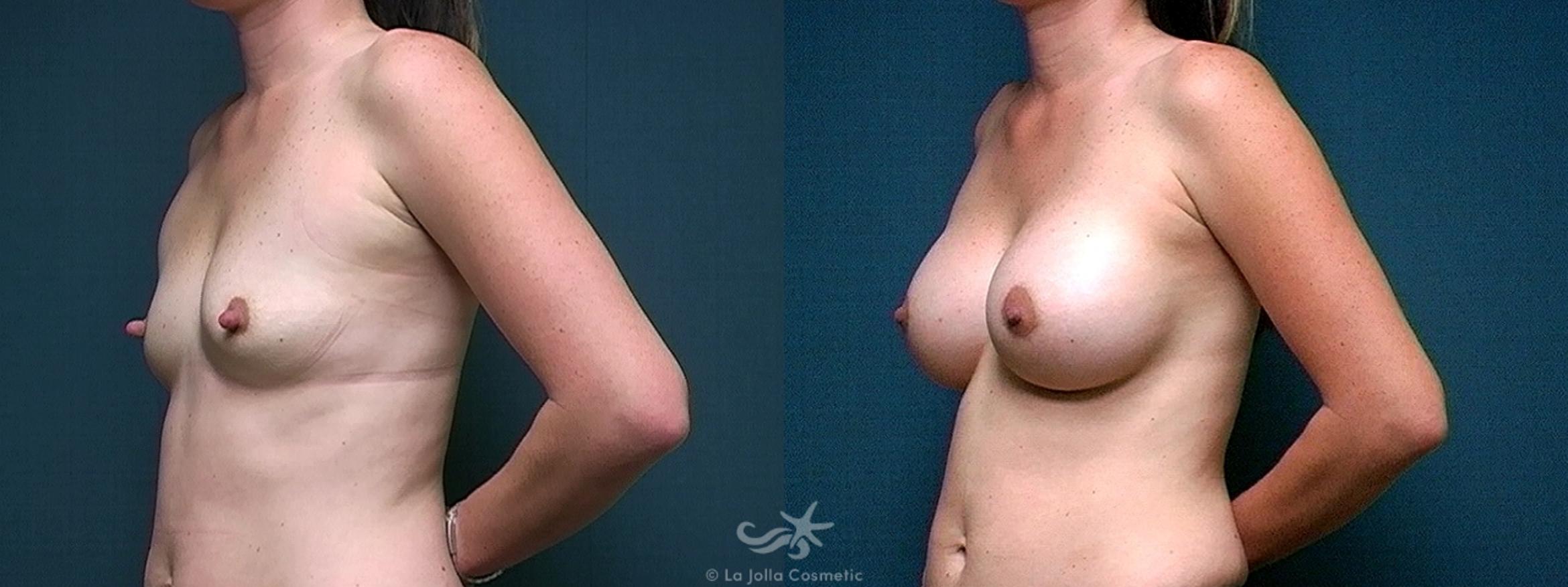 Before & After Breast Augmentation Result 476 Left Oblique View in San Diego, CA