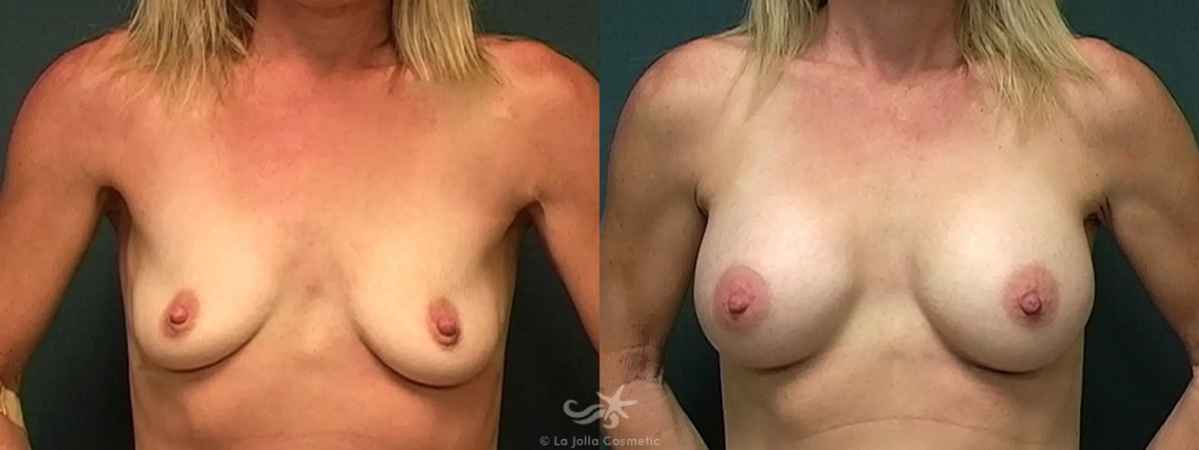 Before & After Breast Augmentation Result 478 Front View in San Diego, CA