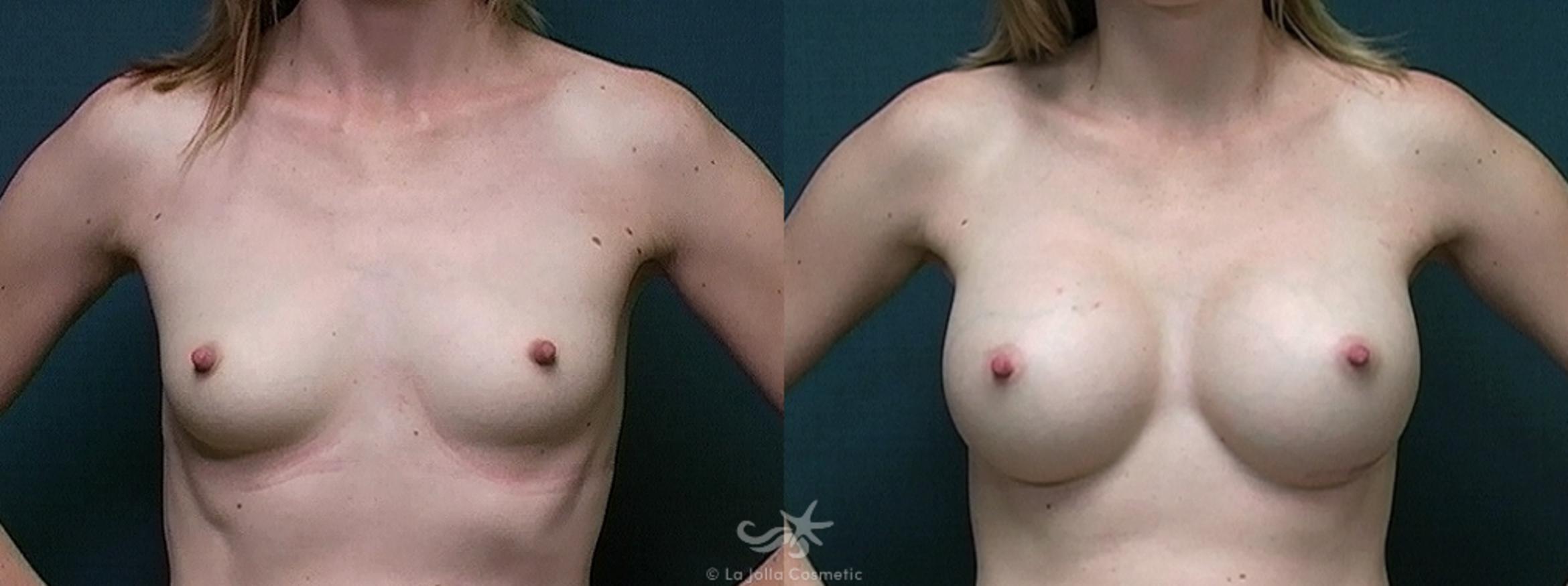 Before & After Breast Augmentation Result 481 Front View in San Diego, CA