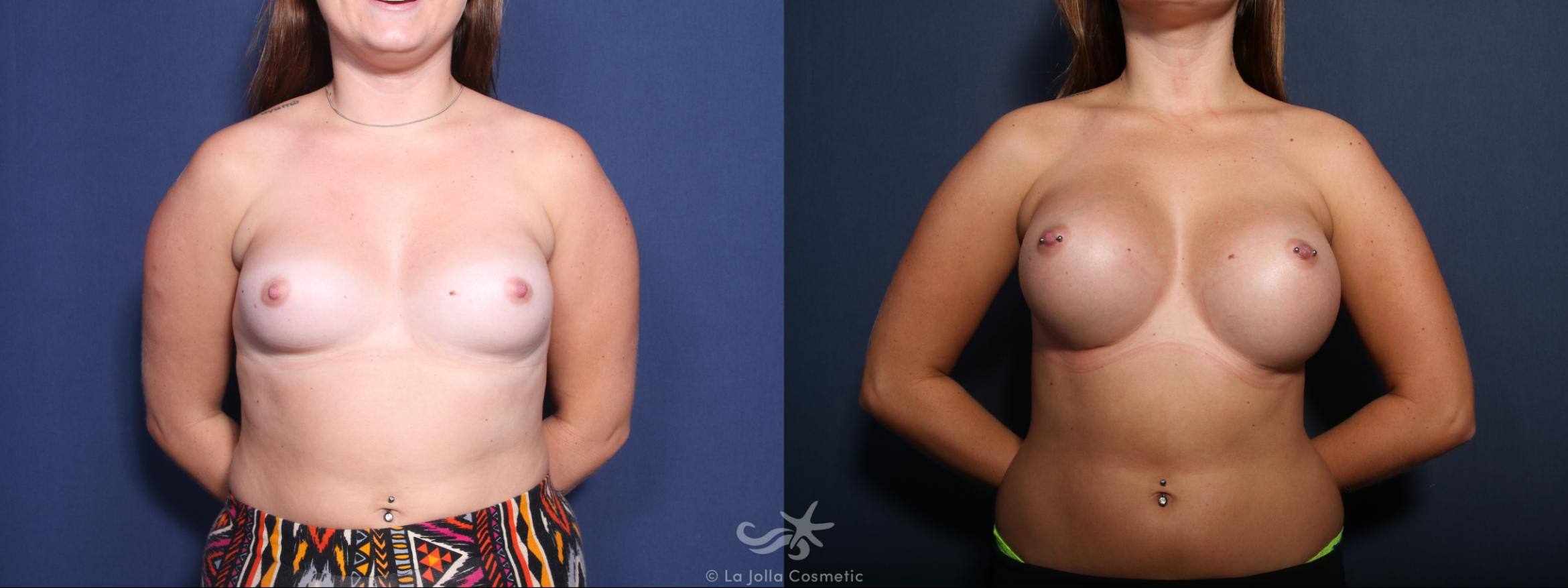Before & After Breast Augmentation Result 482 Front View in San Diego, CA