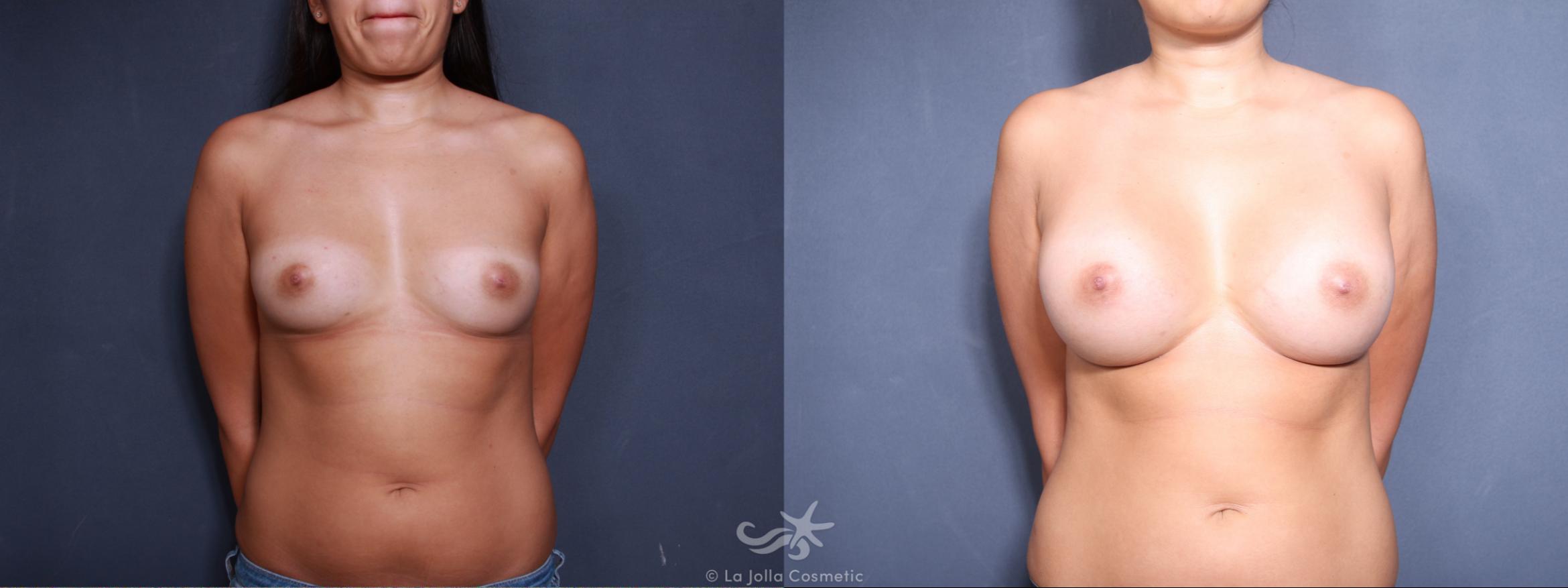 Before & After Breast Augmentation Result 488 Front View in San Diego, CA