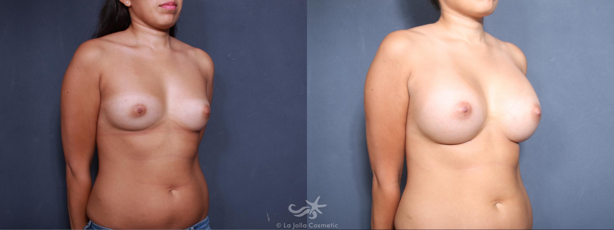 Before & After Breast Augmentation Result 488 Right Oblique View in San Diego, CA