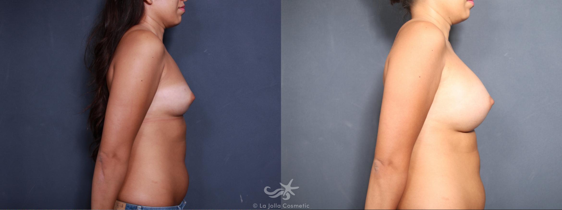Before & After Breast Augmentation Result 488 Right Side View in San Diego, CA