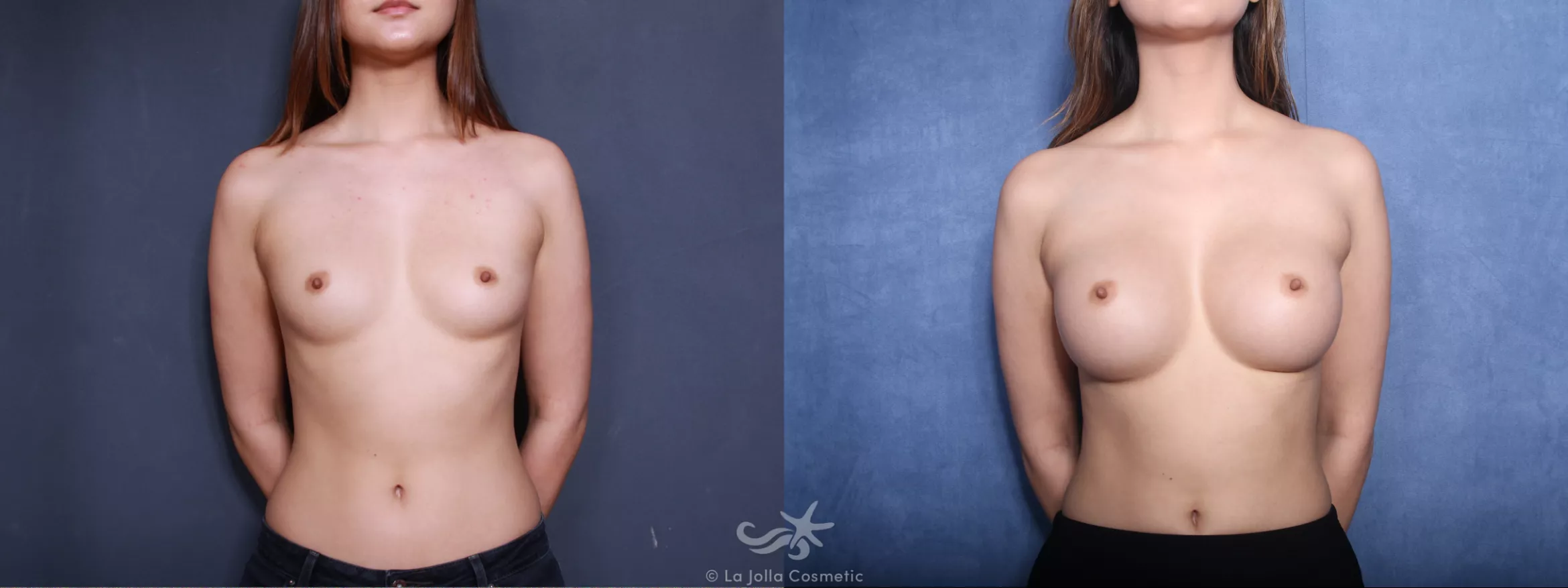 Before & After Breast Augmentation Result 491 Front View in San Diego, CA