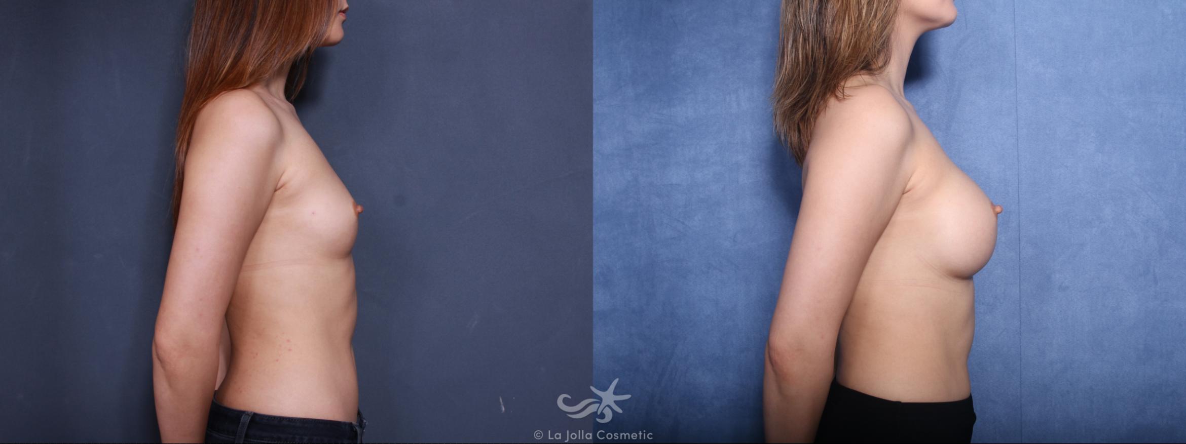 Before & After Breast Augmentation Result 491 Right Side View in San Diego, CA