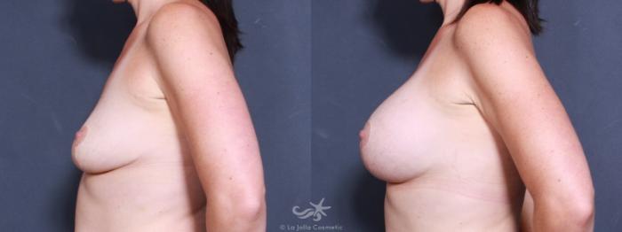 Before & After Breast Augmentation Result 492 Left Side View in San Diego, Carlsbad, CA
