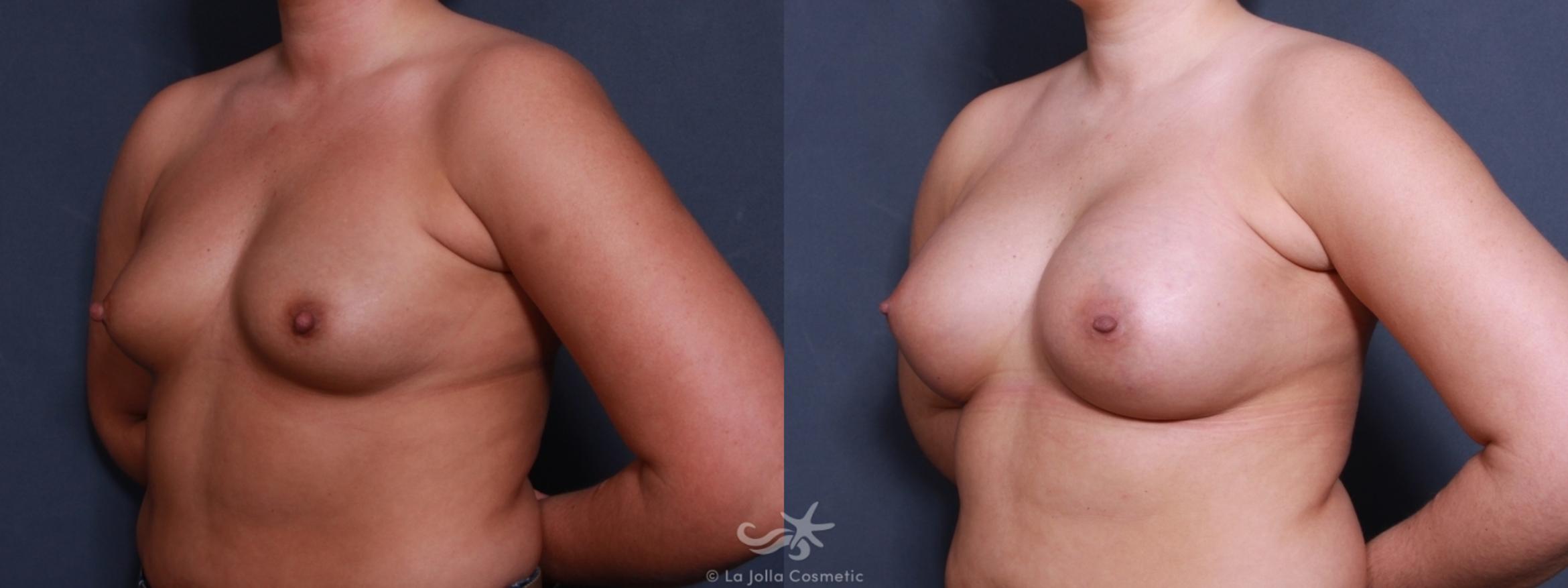 Before & After Breast Augmentation Result 493 Left Oblique View in San Diego, CA