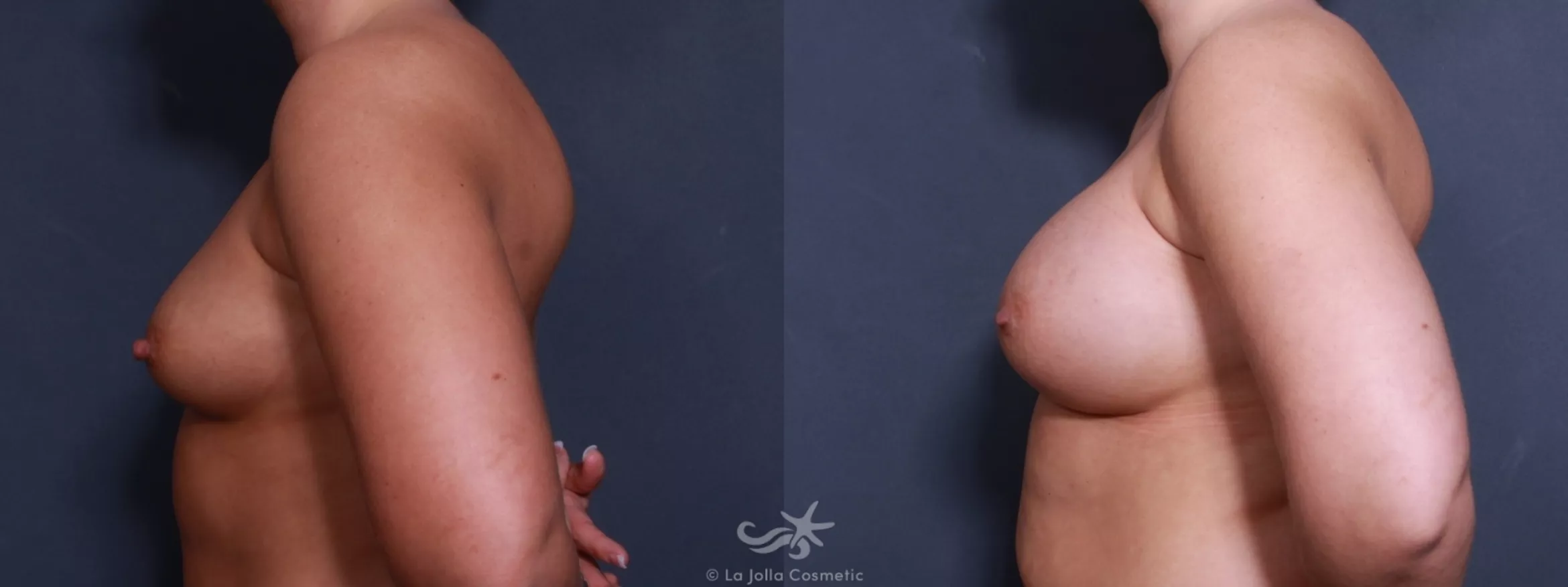 Before & After Breast Augmentation Result 493 Left Side View in San Diego, CA