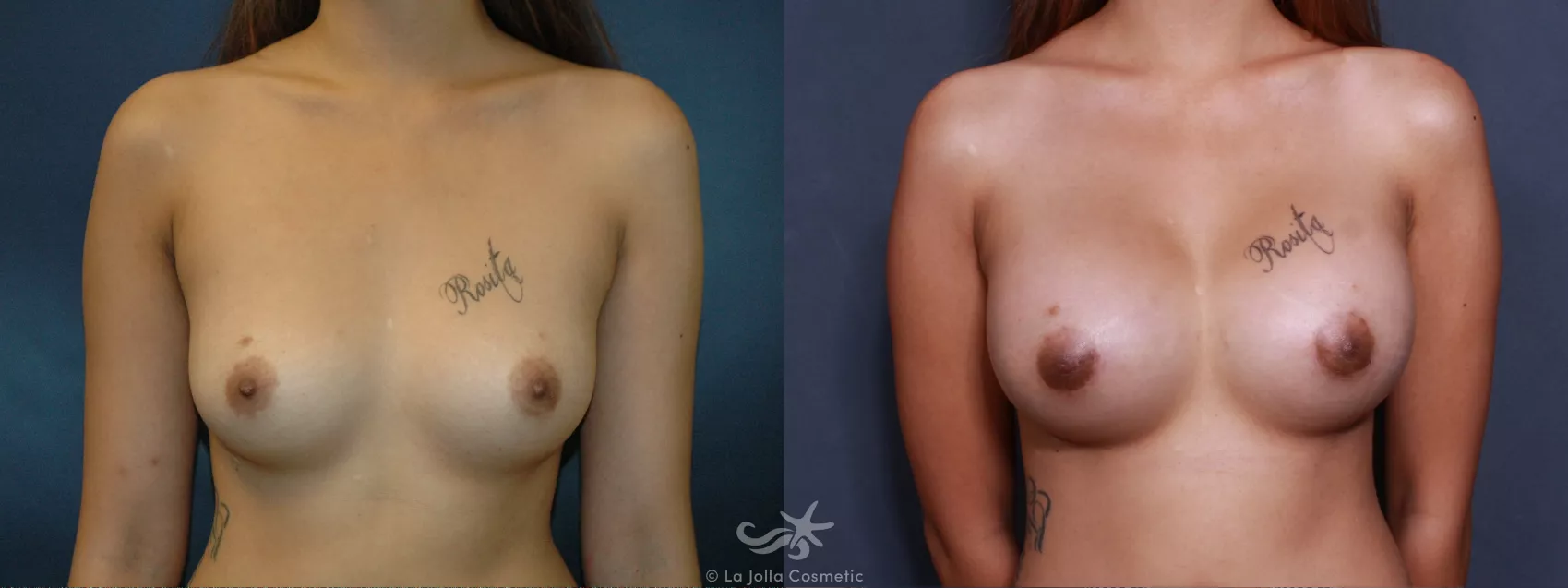 Before & After Breast Augmentation Result 496 Front View in San Diego, CA