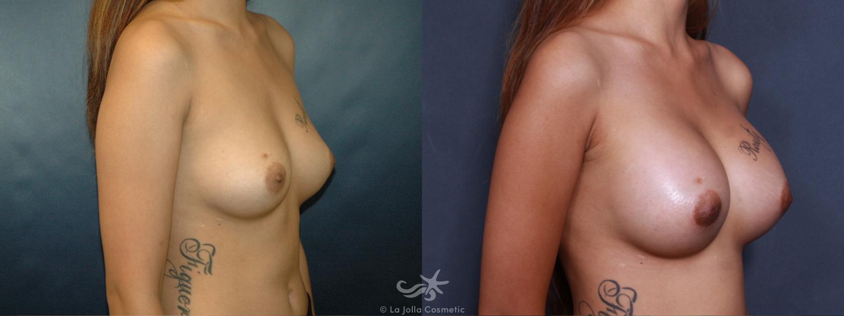 Before & After Breast Augmentation Result 496 Right Oblique View in San Diego, CA
