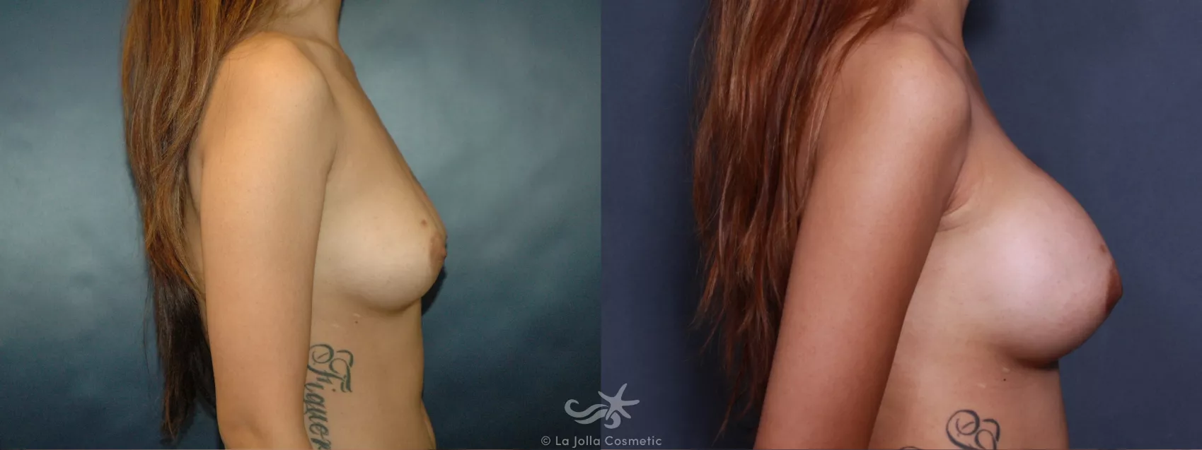 Before & After Breast Augmentation Result 496 Right Side View in San Diego, CA