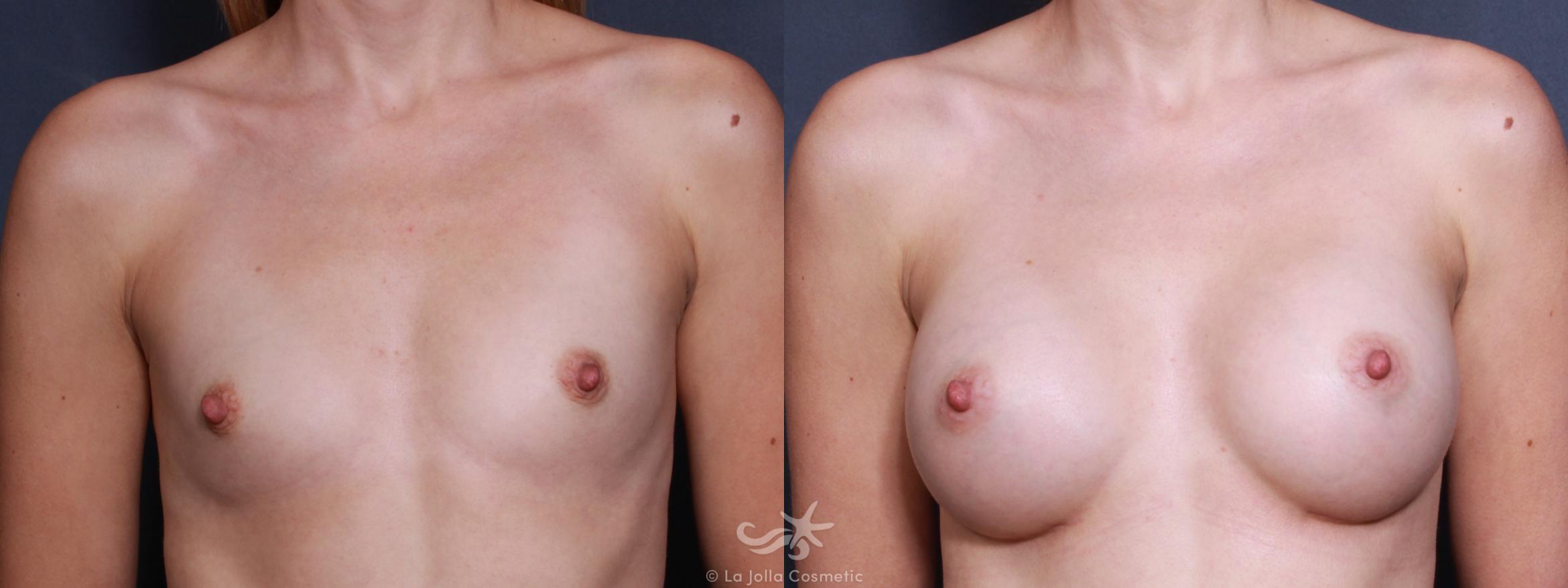 Before & After Breast Augmentation Result 499 Front View in San Diego, CA