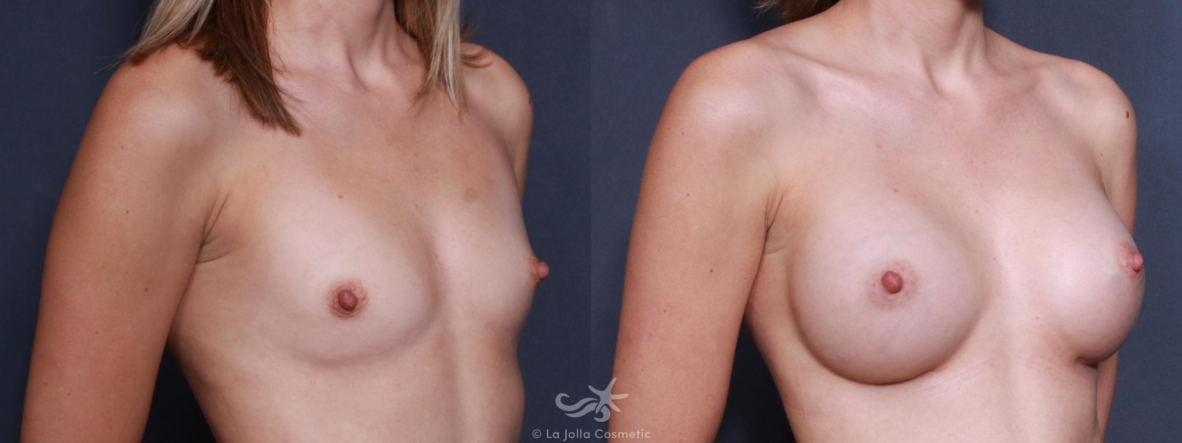 Before & After Breast Augmentation Result 499 Right Oblique View in San Diego, CA