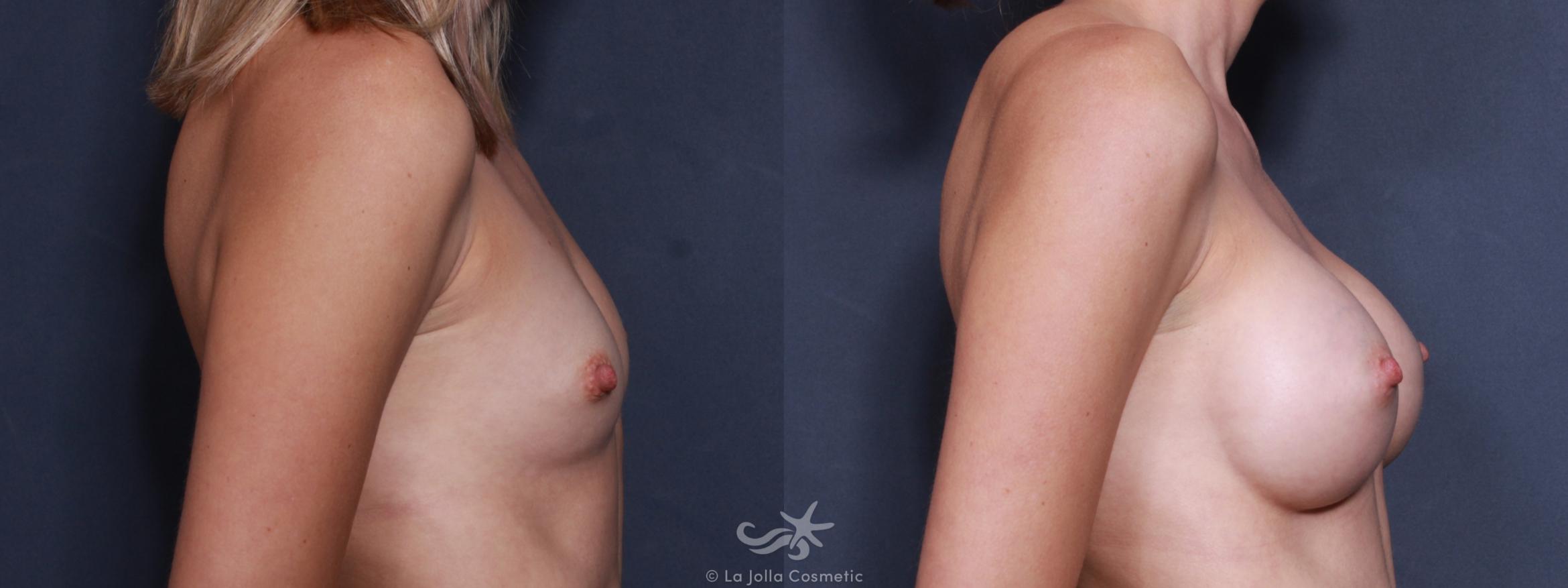 Before & After Breast Augmentation Result 499 Right Side View in San Diego, CA