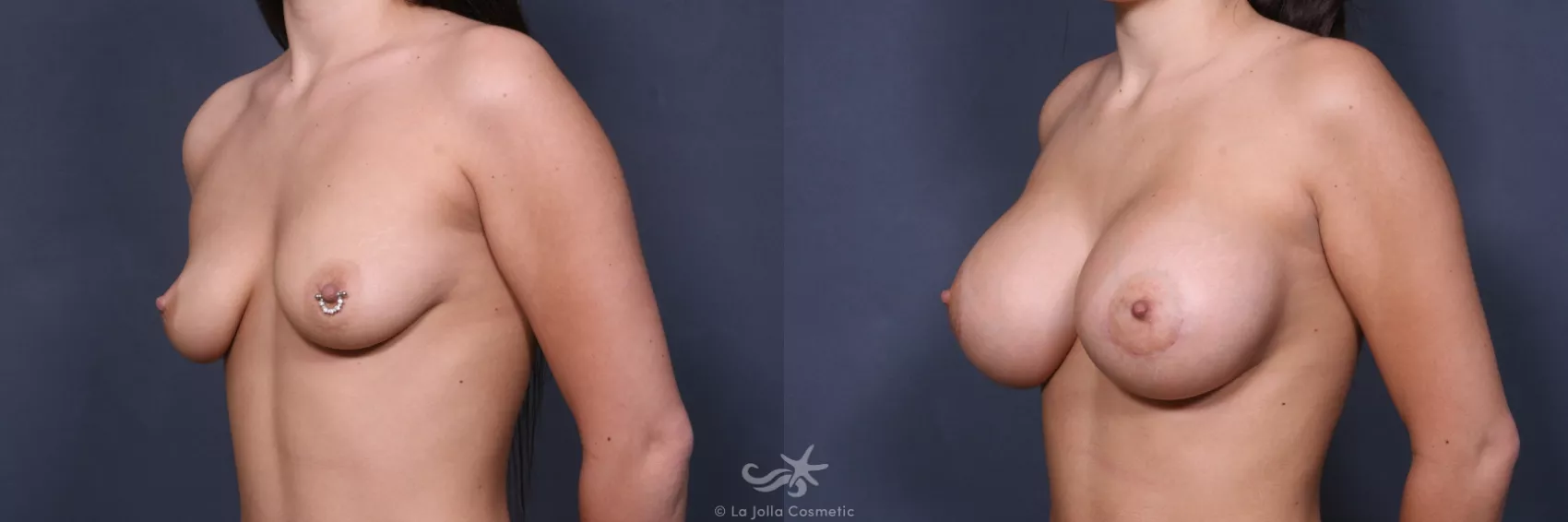 Before & After Breast Augmentation Result 501 Left Oblique View in San Diego, CA