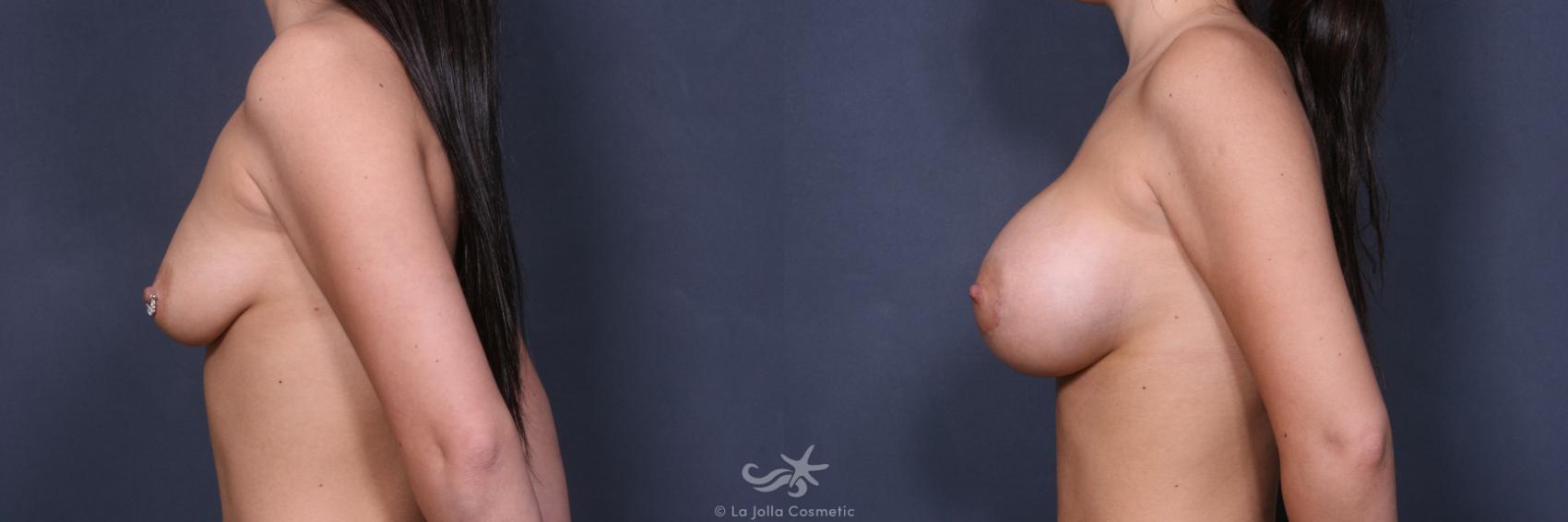 Before & After Breast Augmentation Result 501 Left Side View in San Diego, CA