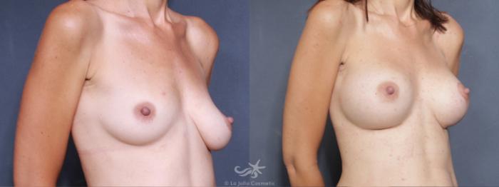 Before & After Breast Augmentation Result 502 Right Oblique View in San Diego, Carlsbad, CA
