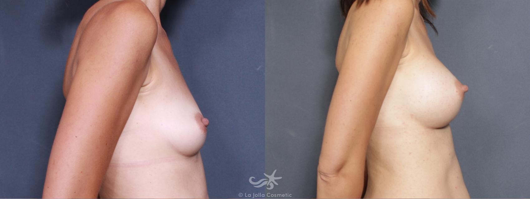 Before & After Breast Augmentation Result 502 Right Side View in San Diego, CA