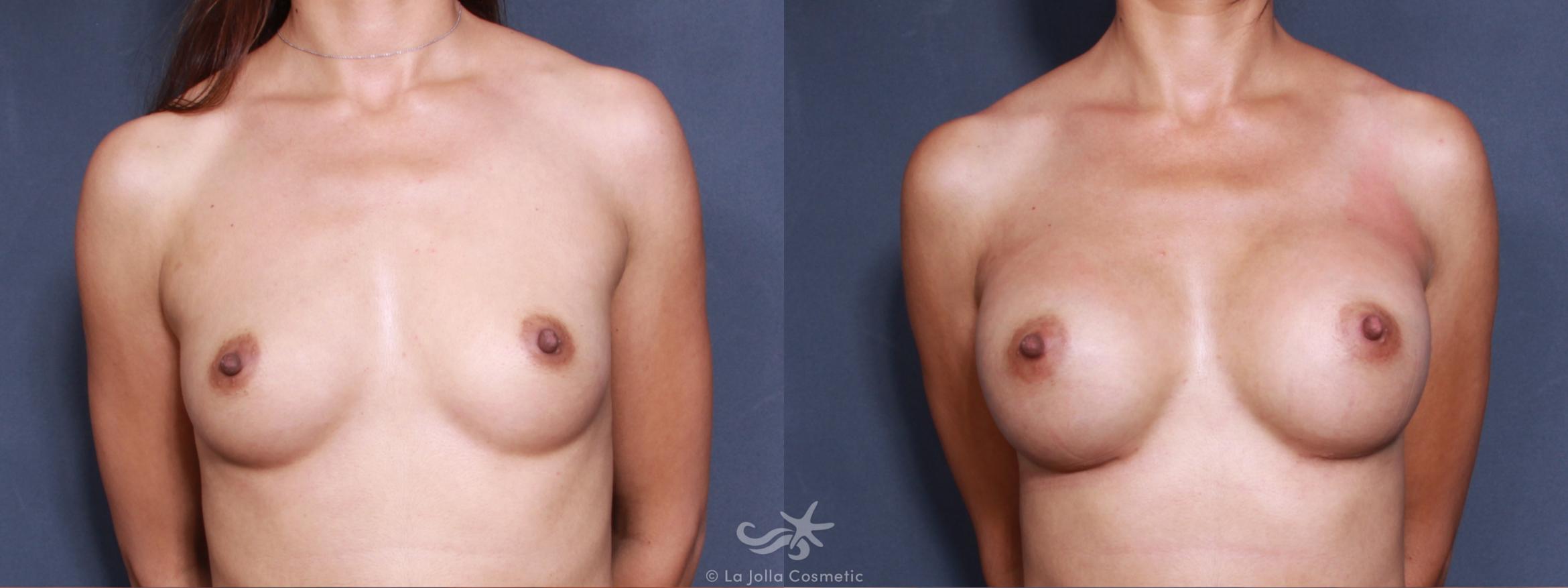 Before & After Breast Augmentation Result 508 Front View in San Diego, CA