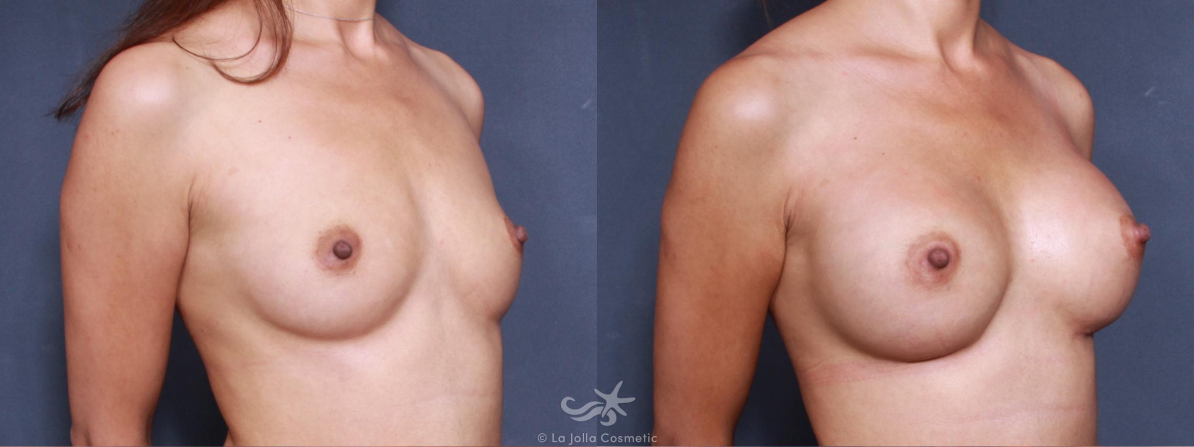 Before & After Breast Augmentation Result 508 Right Oblique View in San Diego, CA