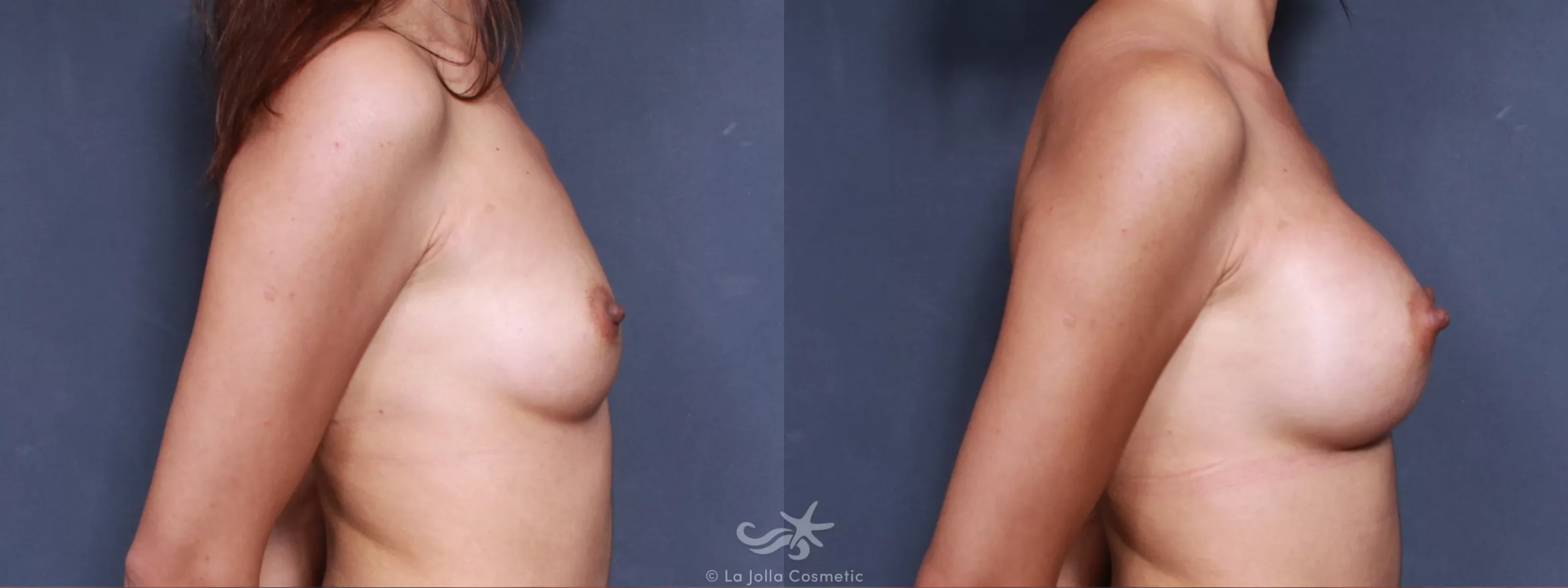 Before & After Breast Augmentation Result 508 Right Side View in San Diego, CA