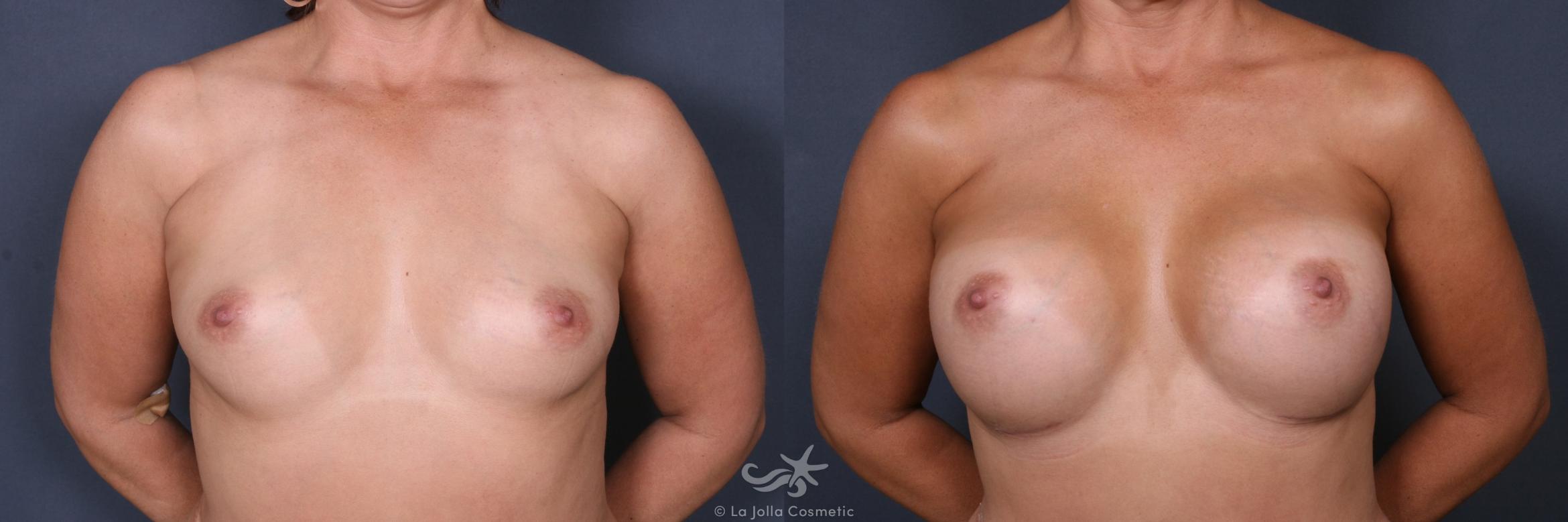 Before & After Breast Augmentation Result 511 Front View in San Diego, CA