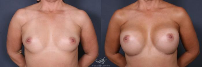 Before & After Breast Augmentation Result 511 Front View in San Diego, Carlsbad, CA