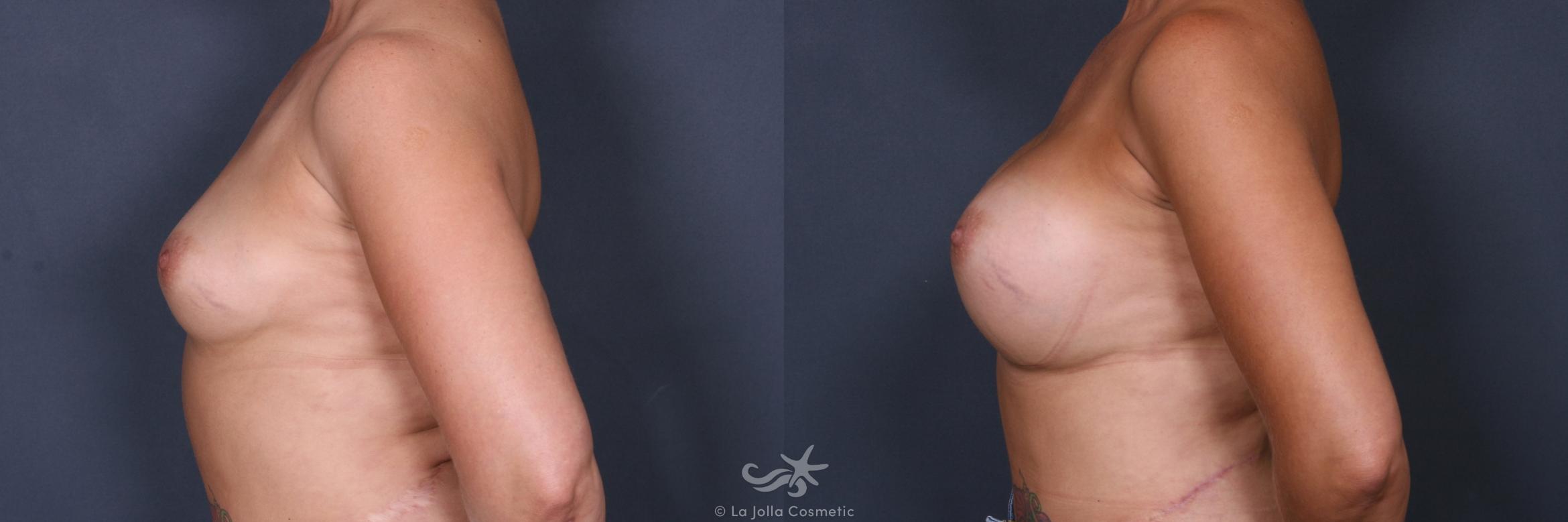Before & After Breast Augmentation Result 511 Left Side View in San Diego, CA