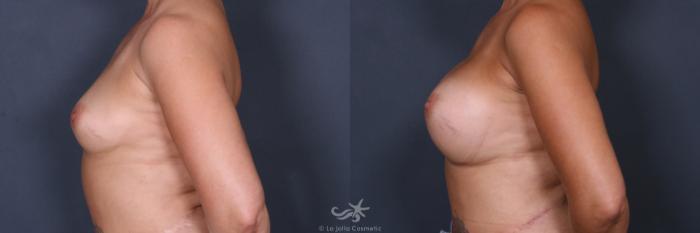 Before & After Breast Augmentation Result 511 Left Side View in San Diego, Carlsbad, CA