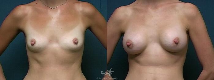 Before & After Breast Augmentation Result 514 Front View in San Diego, Carlsbad, CA