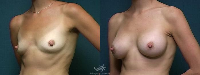 Before & After Breast Augmentation Result 514 Left Oblique View in San Diego, Carlsbad, CA