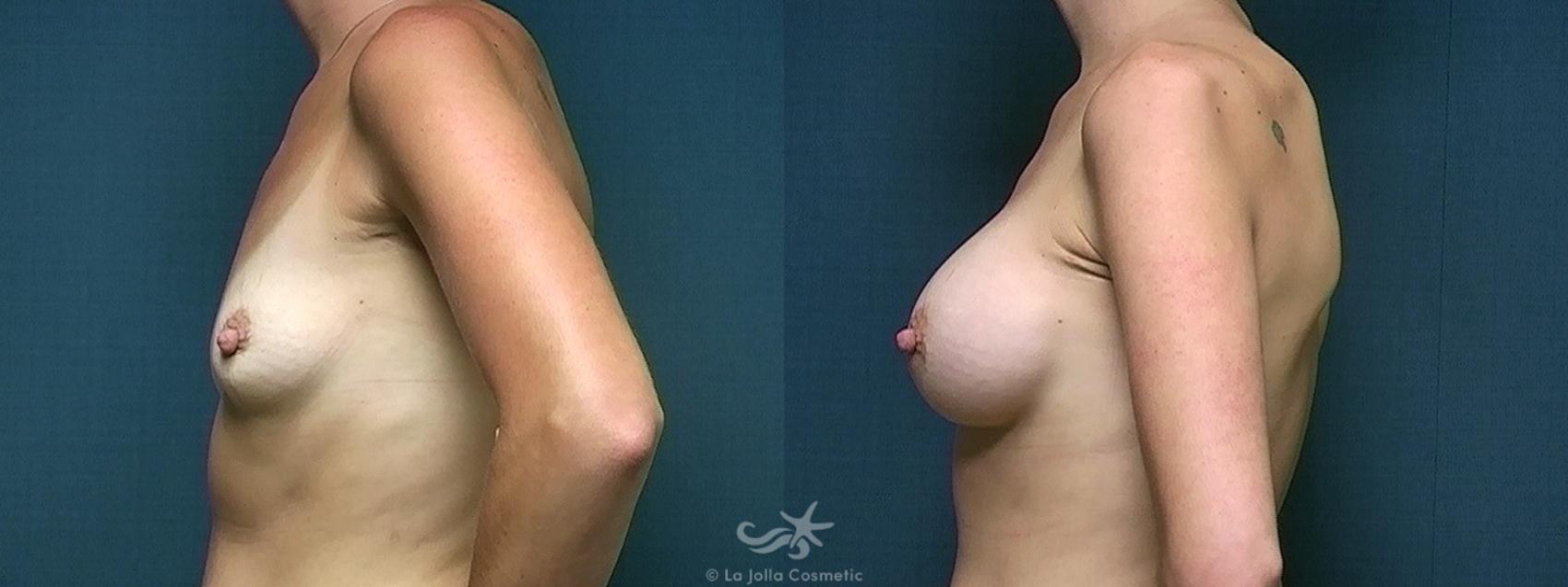 Before & After Breast Augmentation Result 514 Left Side View in San Diego, CA