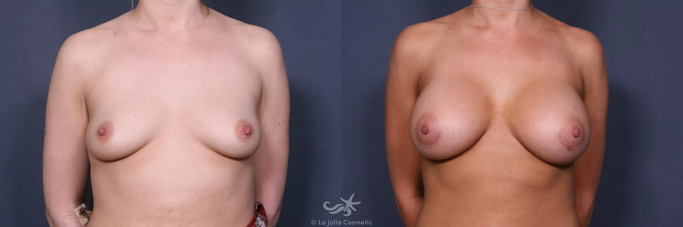 Before & After Breast Augmentation Result 515 Front View in San Diego, CA