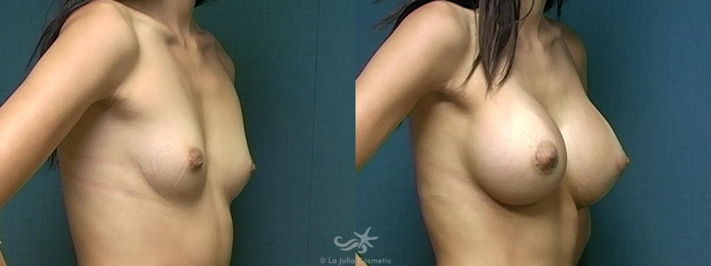 Before & After Breast Augmentation Result 520 Right Oblique View in San Diego, CA