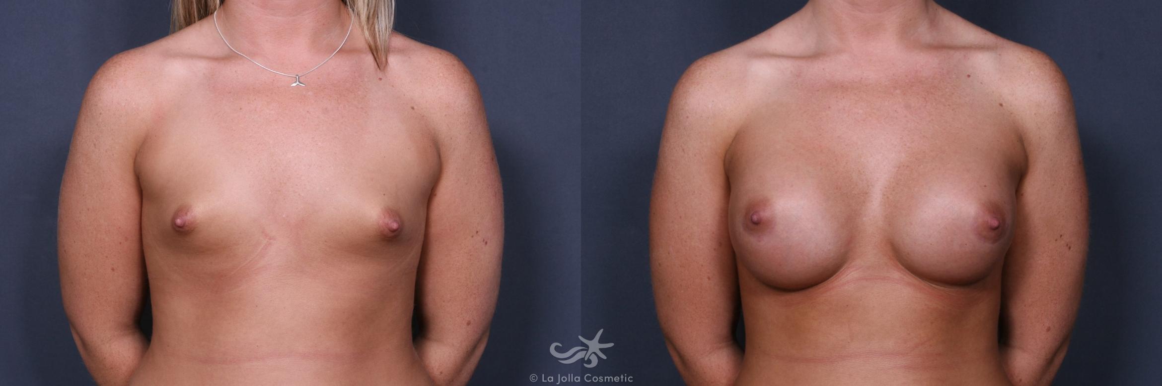 Before & After Breast Augmentation Result 529 Front View in San Diego, CA