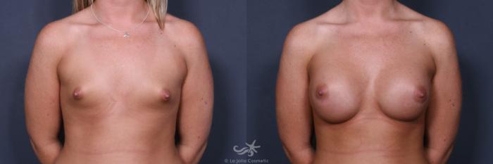Before & After Breast Augmentation Result 529 Front View in San Diego, Carlsbad, CA